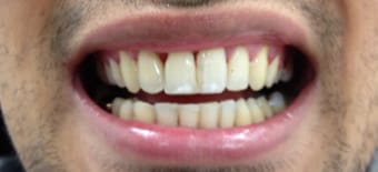 After cosmetic Treatment Smile Rooms 
