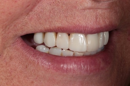 After Smile Makeover Treatment Smile Rooms 