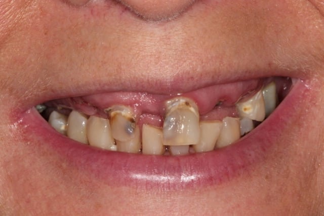 Before Implant