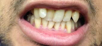 Before and After Invisalign Treatment Milton Keynes