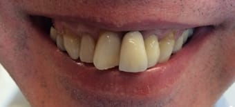 Before and After Invisalign Treatment Milton Keynes