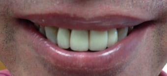 Before and After Invisalign Treatment Milton Keynes
