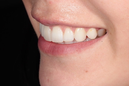 After Invisalign Treatment Reading Smiles