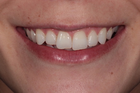 Before Invisalign Treatment Reading Smiles
