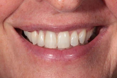 Before and After Invisalign Treatment Milton Keynes
