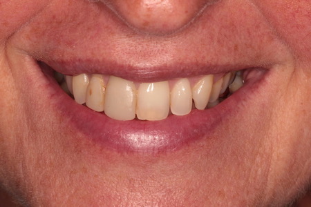 Before and After Invisalign Treatment Milton Keynes