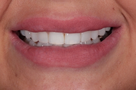 After Invisalign Treatment Reading Smiles