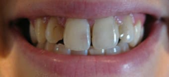 Before and After Invisalign Treatment Milton Keynes