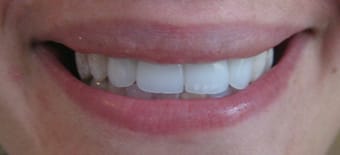 Before and After Invisalign Treatment Milton Keynes