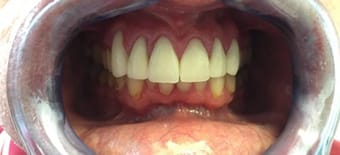 Before and After Invisalign Treatment Milton Keynes