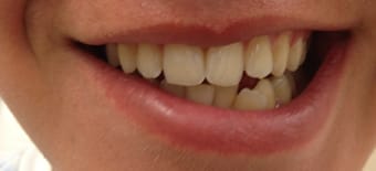 Before and After Invisalign Treatment Milton Keynes