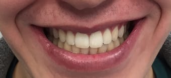 Before and After Invisalign Treatment Milton Keynes