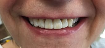 Before and After Invisalign Treatment Milton Keynes