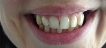 Before and After Invisalign Treatment Milton Keynes