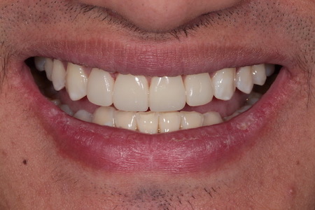 After Invisalign Treatment Reading Smiles