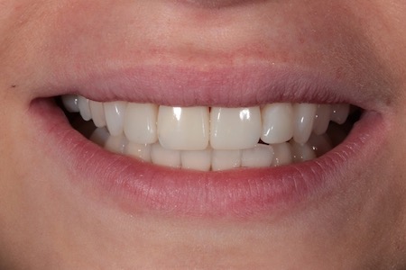 Before and After Invisalign Treatment Milton Keynes