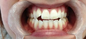 Before and After Invisalign Treatment Milton Keynes