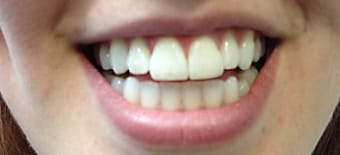 Before and After Invisalign Treatment Milton Keynes