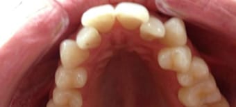 Before and After Invisalign Treatment Milton Keynes
