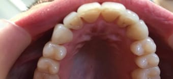 Before and After Invisalign Treatment Milton Keynes