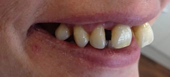 Before and After Invisalign Treatment Milton Keynes