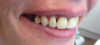 Before and After Invisalign Treatment Milton Keynes
