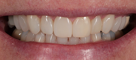 After Invisalign Treatment Reading Smiles