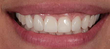 After Invisalign Treatment Reading Smiles