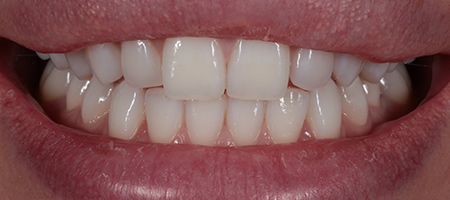 Composite Bonding Cases