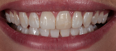 Composite Bonding Cases
