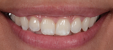 Composite Bonding Cases