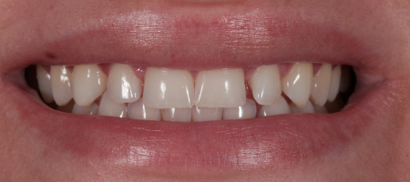 Composite Bonding Cases