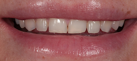 Composite Bonding Cases
