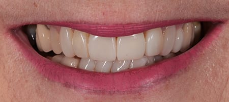 After Invisalign Treatment Reading Smiles