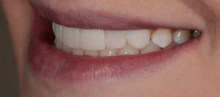 After Invisalign Treatment Reading Smiles