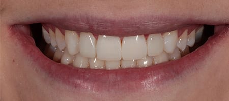 After Invisalign Treatment Reading Smiles