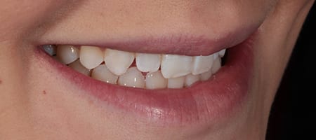 Composite Bonding Cases