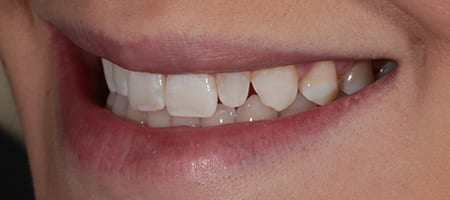 Composite Bonding Cases