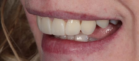 After Invisalign Treatment Reading Smiles