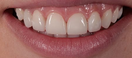 After Invisalign Treatment Reading Smiles