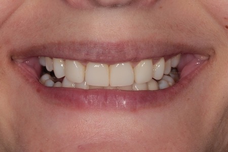 After Invisalign Treatment Reading Smiles