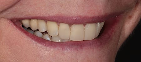 After Invisalign Treatment Reading Smiles
