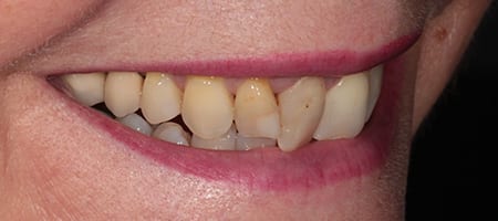 Composite Bonding Cases