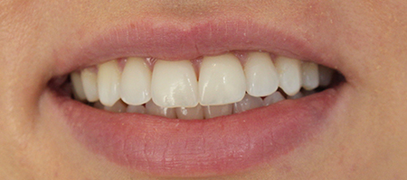 Before and After Invisalign Treatment Milton Keynes Before and After Invisalign Treatment Milton Keynes