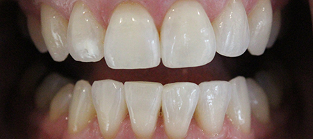 Before and After Invisalign Treatment Milton Keynes Before and After Invisalign Treatment Milton Keynes