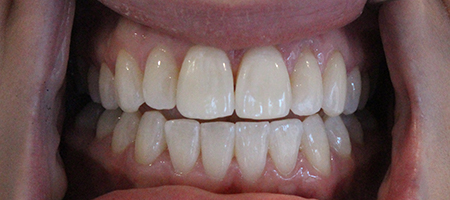 Before and After Invisalign Treatment Milton Keynes Before and After Invisalign Treatment Milton Keynes