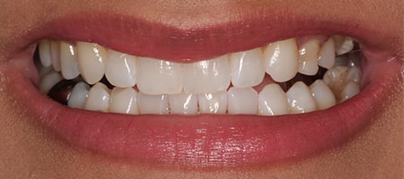 Before and After Invisalign Treatment Milton Keynes Before and After Invisalign Treatment Milton Keynes