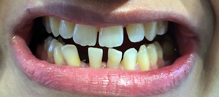 Before and After Invisalign Treatment Milton Keynes Before and After Invisalign Treatment Milton Keynes