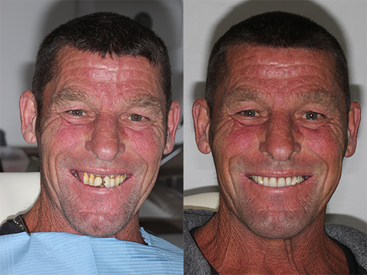 all-on-4-dental-implants