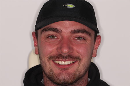 Before and After Invisalign Treatment Milton Keynes Before and After Invisalign Treatment Milton Keynes